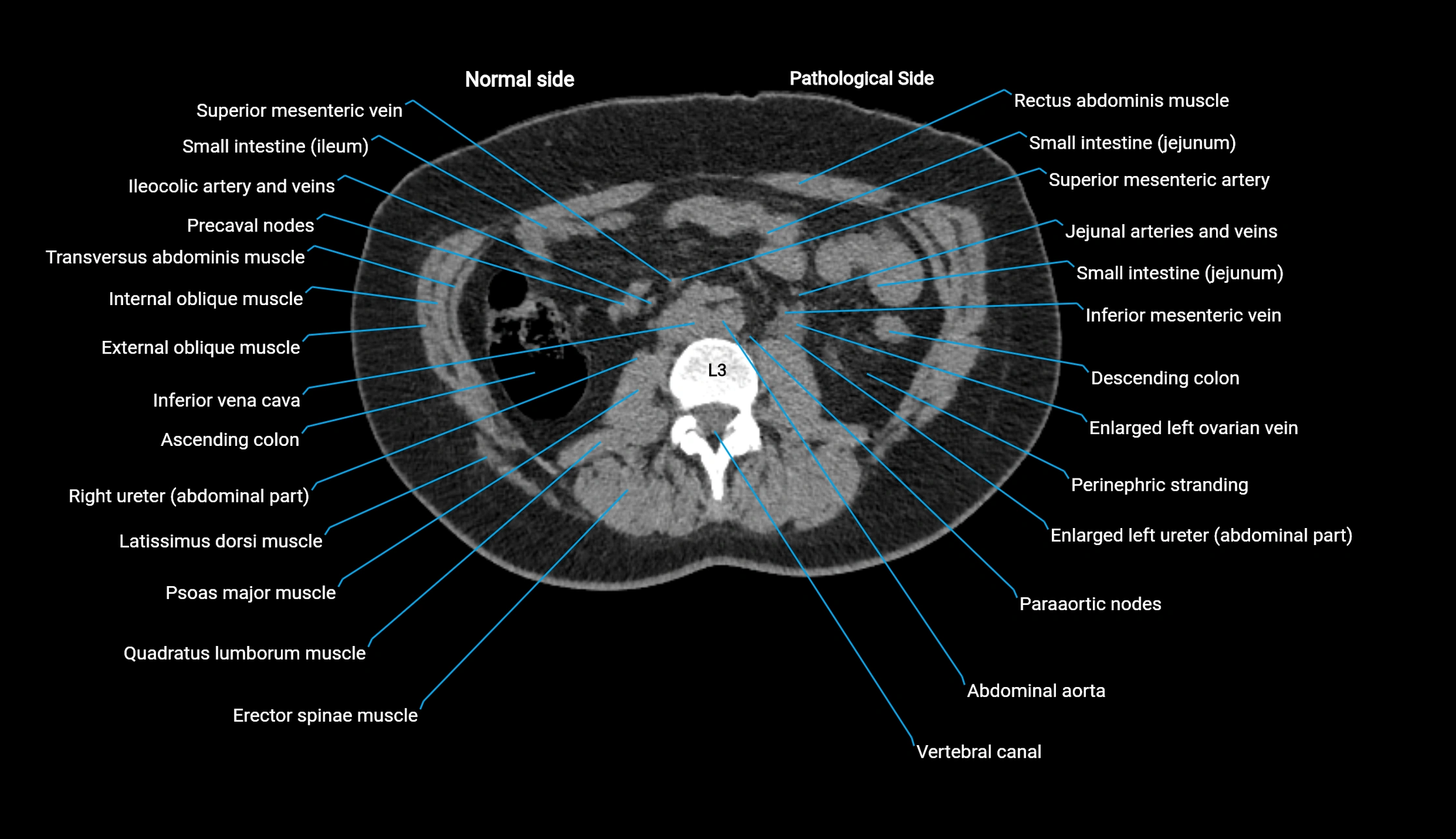 CT KUB axial cross sectional anatomy  radiology image -img-00201-00067.webp